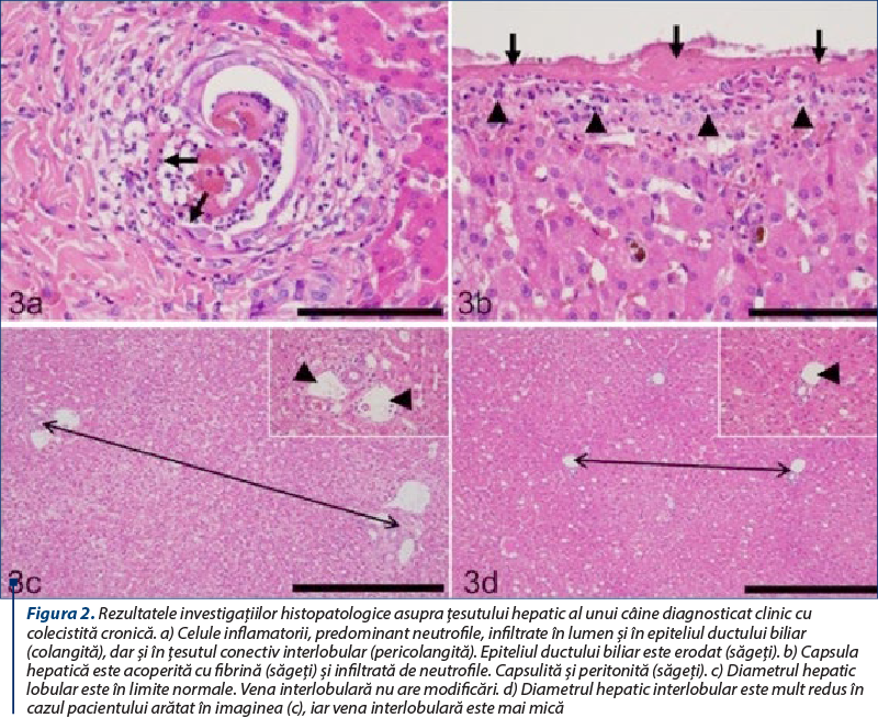 Figura 2. Rezultatele investigaţiilor histopatologice asupra ţesutului hepatic al unui câine diagnosticat clinic cu colecistită cronică. a) Celule inflamatorii, predominant neutrofile, infiltrate în lumen şi în epiteliul ductului biliar (colangită), dar şi în ţesutul conectiv interlobular (pericolangită). Epiteliul ductului biliar este erodat (săgeţi). b) Capsula hepatică este acoperită cu fibrină (săgeţi) şi infiltrată de neutrofile. Capsulită şi peritonită (săgeţi). c) Diametrul hepatic lobular este în limite normale. Vena interlobulară nu are modificări. d) Diametrul hepatic interlobular este mult redus în cazul pacientului arătat în imaginea (c), iar vena interlobulară este mai mică