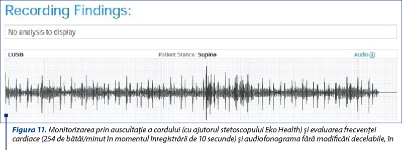 Figura 11. Monitorizarea prin auscultaţie a cordului (cu ajutorul stetoscopului Eko Health) şi evaluarea frecvenţei cardiace (254 de bătăi/minut în momentul înregistrării de 10 secunde) şi audiofonograma fără modificări decelabile, în timpul operaţiei (original)
