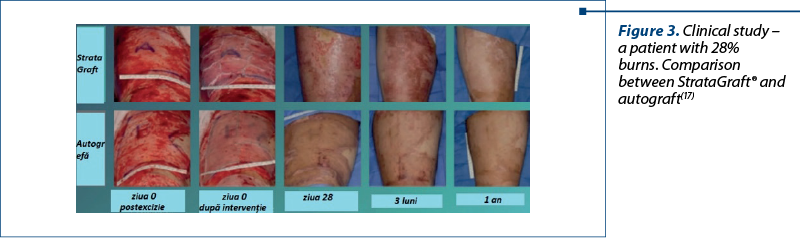 Figure 3. Clinical study –  a patient with 28% burns. Comparison between StrataGraft® and autograft(17)