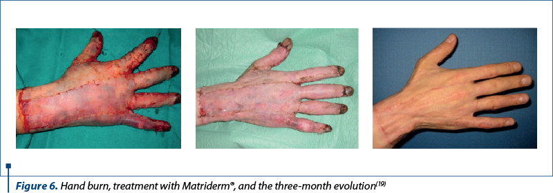 Figure 6. Hand burn, treatment with Matriderm®, and the three-month evolution(19)7