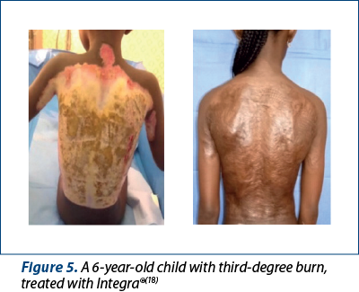 Figure 5. A 6-year-old child with third-degree burn, treated with Integra®(18)
