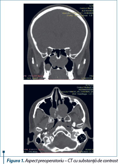 Figura 1. Aspect preoperatoriu – CT cu substanţă de contrast