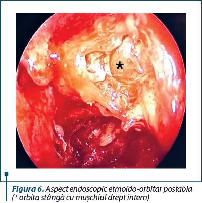 Figura 6. Aspect endoscopic etmoido-orbitar post­abla­ţie (* orbita stângă cu muşchiul drept intern)