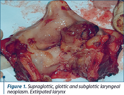 Figure 1. Supraglottic, glottic and subglottic laryngeal neoplasm. Extirpated larynx