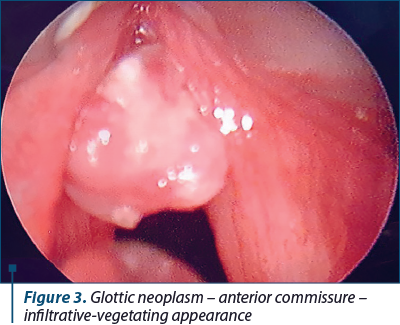 Figure 3. Glottic neoplasm – anterior commissure – infiltrative-vegetating appearance