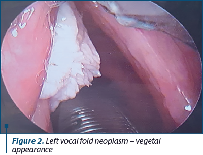 Figure 2. Left vocal fold neoplasm – vegetal  appearance