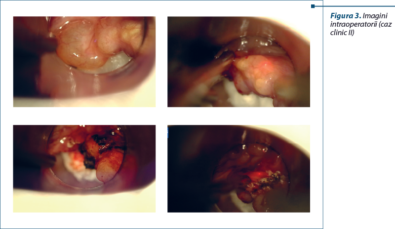 Figura 3. Imagini intraoperatorii (caz clinic II)