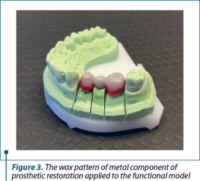Figure 3. The wax pattern of metal component of prosthetic restoration applied to the functional model
