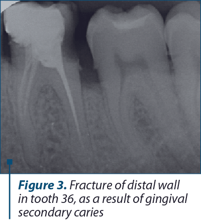 Figure 3. Fracture of distal wall in tooth 36, as a result of gingival secondary caries