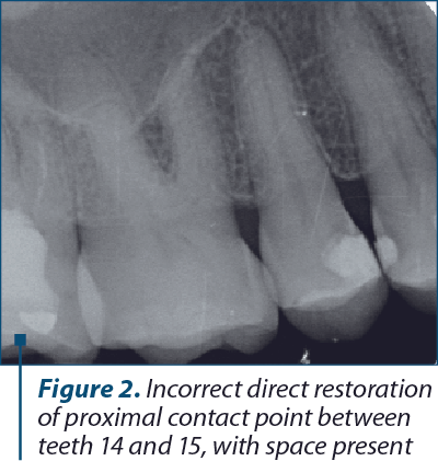 Figure 2. Incorrect direct restora­tion of proximal contact point between teeth 14 and 15, with space present