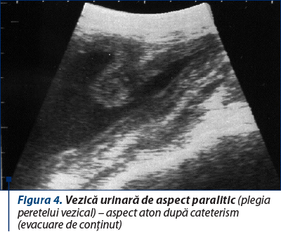 Figura 4. Vezică urinară de aspect paralitic (plegia peretelui vezical) – aspect aton după cateterism (evacuare de conţinut)
