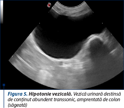 Figura 5. Hipotonie vezicală. Vezică urinară destinsă de conţinut abundent transsonic, amprentată de colon (săgeată)