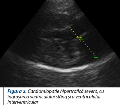 Figura 2. Cardiomiopatie hipertrofică severă, cu îngroşarea ventriculului stâng şi a ventriculului interventricular