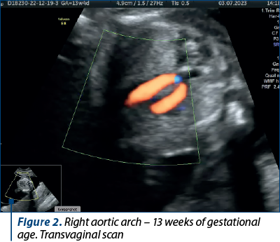 Figure 2. Right aortic arch – 13 weeks of gestational age. Transvaginal scan