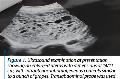Figure 1. Ultrasound examination at presentation showing an enlarged uterus with dimensions of 14/11 cm, with intrauterine inhomogeneous contents similar to a bunch of grapes. Transabdominal probe was used
