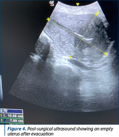 Figure 4. Post-surgical ultrasound showing an empty uterus after evacuation 