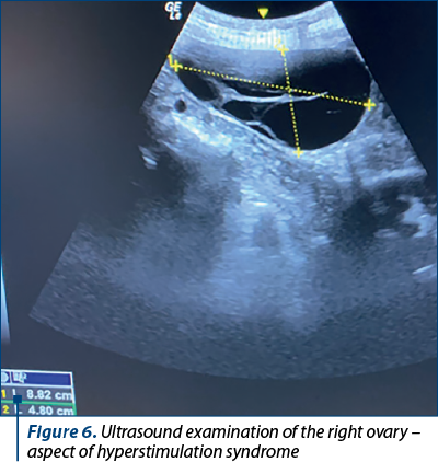 Figure 6. Ultrasound examination of the right ovary – aspect of hyperstimulation syndrome