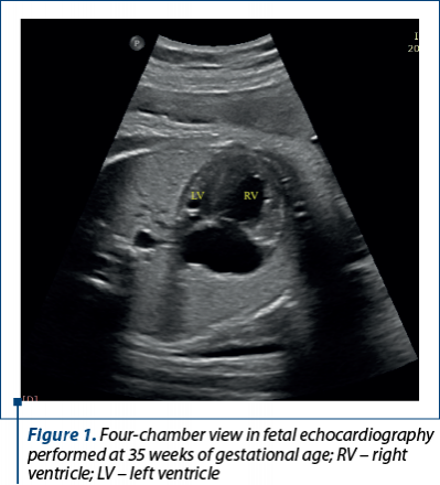 Figure 1. Four-chamber view in fetal echocardiography performed at 35 weeks of gestational age; RV – right ventricle; LV – left ventricle
