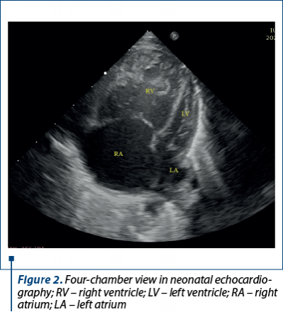 Figure 2. Four-chamber view in neonatal echocardio­graphy; RV – right ventricle; LV – left ventricle; RA – right atrium; LA – left atrium