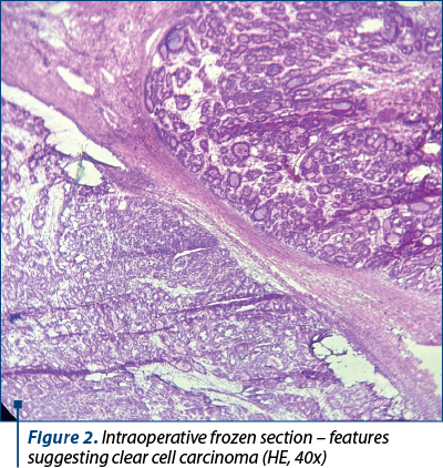Figure 2. Intraoperative frozen section – features suggesting clear cell carcinoma (HE, 40x)