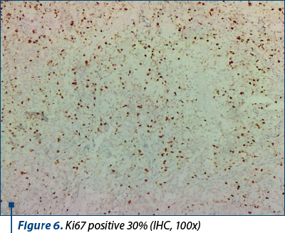Figure 6. Ki67 positive 30% (IHC, 100x)