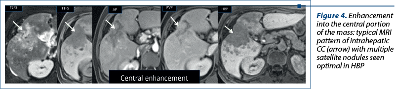 Figure 4. Enhancement into the central portion of the mass: typical MRI pattern of intrahepatic CC (arrow) with multiple satellite nodules seen optimal in HBP