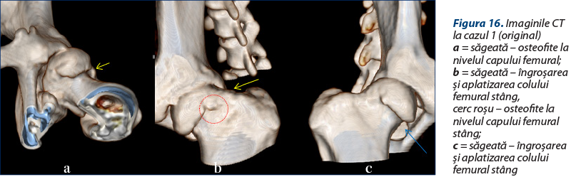 Figura 16. Imaginile CT la cazul 1 (original) a = săgeată – osteofite la nivelul capului femural; b = săgeată – îngroşarea şi aplatizarea colului femural stâng,  cerc roşu – osteofite la nivelul capului femural stâng;  c = săgeată – îngroşarea şi aplatizarea colului femural stâng