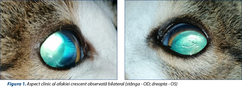 Figura 1. Aspect clinic al afakiei crescent observată bilateral (stânga - OD; dreapta - OS)
