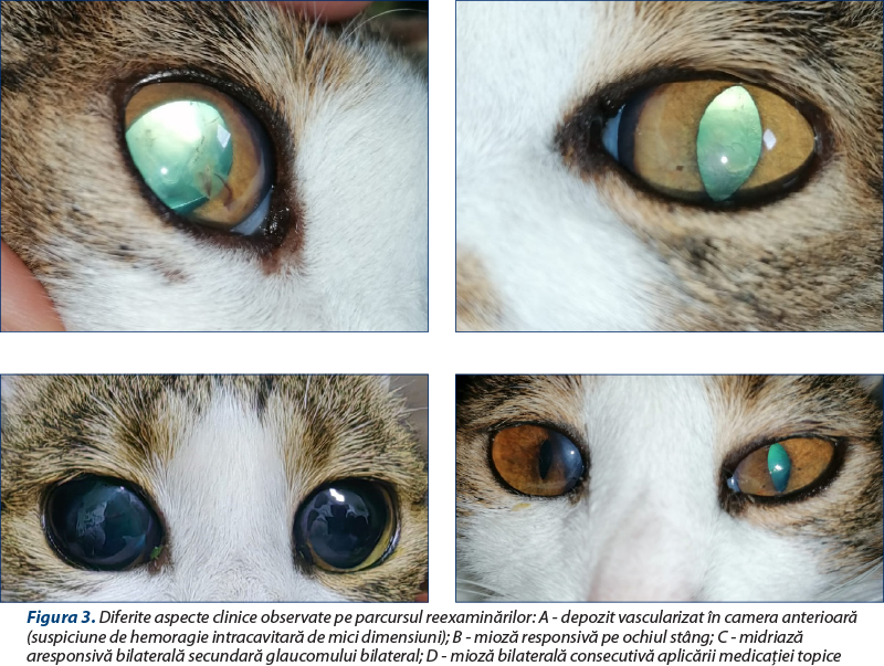 Figura 3. Diferite aspecte clinice observate pe parcursul reexaminărilor: A - depozit vascularizat în camera anterioară (suspiciune de hemoragie intracavitară de mici dimensiuni); B - mioză responsivă pe ochiul stâng; C - midriază aresponsivă bilaterală secundară glaucomului bilateral; D - mioză bilaterală consecutivă aplicării medicaţiei topice 