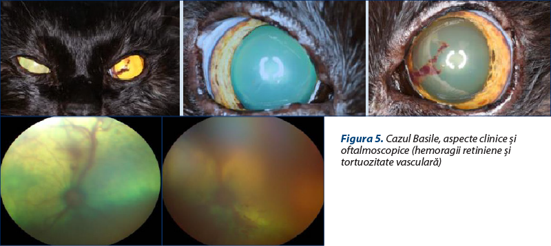 Figura 5. Cazul Basile, aspecte clinice şi oftalmoscopice (hemoragii retiniene şi tortuozitate vasculară)