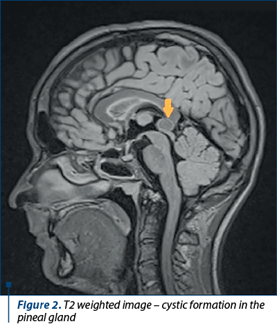 Figure 2. T2 weighted image – cystic formation in the pineal gland