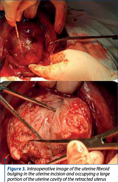 Figure 3. Intraoperative image of the uterine fibroid bulging in the uterine incision and occupying a large portion of the uterine cavity of the retracted uterus