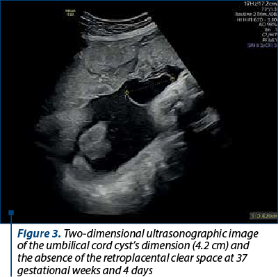 Figure 3. Two-dimensional ultrasonographic image of the umbilical cord cyst’s dimension (4.2 cm) and the absence of the retroplacental clear space at 37 gestational weeks and 4 days