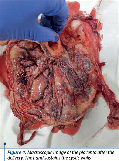 Figure 4. Macroscopic image of the placenta after the delivery. The hand sustains the cystic walls