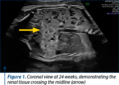 Figure 1. Coronal view at 24 weeks, demonstrating the renal tissue crossing the midline (arrow)