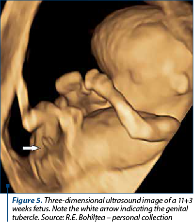 Figure 5. Three-dimensional ultrasound image of a 11+3 weeks fetus. Note the white arrow indicating the genital tubercle. Source: R.E. Bohîlţea – personal collection