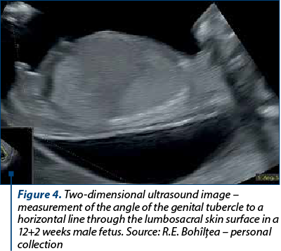 Figure 4. Two-dimensional ultrasound image – measurement of the angle of the genital tubercle to a horizontal line through the lumbosacral skin surface in a 12+2 weeks male fetus. Source: R.E. Bohîlţea – personal collection