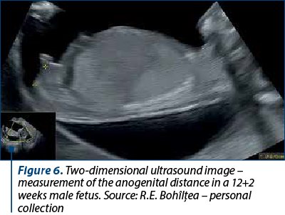 Figure 6. Two-dimensional ultrasound image – measurement of the anogenital distance in a 12+2 weeks male fetus. Source: R.E. Bohîlţea – personal collection