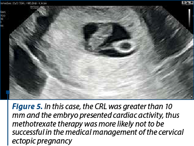 Figure 5. In this case, the CRL was greater than 10 mm and the embryo presented cardiac activity, thus methotrexate therapy was more likely not to be successful in the medical management of the cervical ectopic pregnancy