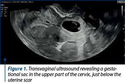 Figure 1. Transvaginal ultrasound revealing a gesta­tio­nal sac in the upper part of the cervix, just below the uterine scar 