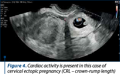 Figure 4. Cardiac activity is present in this case of cervical ectopic pregnancy (CRL – crown-rump length)