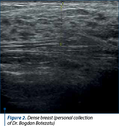 Figure 2. Dense breast (personal collection  of Dr. Bogdan Botezatu)