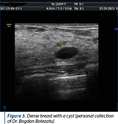 Figure 3. Dense breast with a cyst (personal collection of Dr. Bogdan Botezatu)