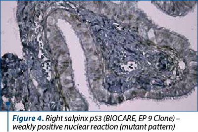 Figure 4. Right salpinx p53 (BIOCARE, EP 9 Clone) – weakly positive nuclear reaction (mutant pattern)