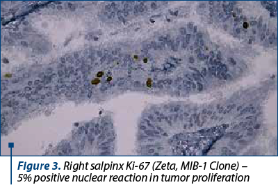 Figure 3. Right salpinx Ki-67 (Zeta, MIB-1 Clone) –  5% positive nuclear reaction in tumor proliferation