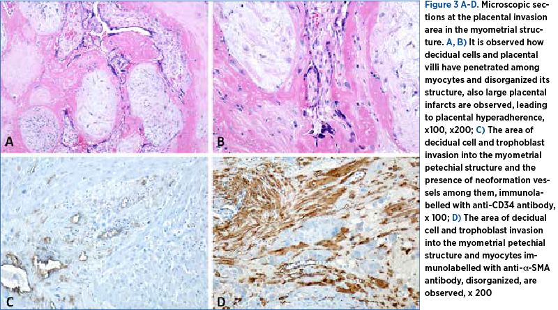 Figure 3 A-D. Microscopic sections at the placental invasion area in the myometrial structure. A, B) It is observed how decidual cells and placental villi have penetrated among myocytes and disorganized its structure, also large placental infarcts are observed, leading to placental hyperadherence, x100, x200; C) The area of decidual cell and trophoblast invasion into the myometrial petechial structure and the presence of neoformation vessels among them, immunolabelled with anti-CD34 antibody, x 100; D) The area of decidual cell and trophoblast invasion into the myometrial petechial structure and myocytes immunolabelled with anti-α-SMA antibody, disorganized, are observed, x 200 