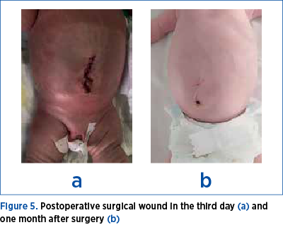 Figure 5. Postoperative surgical wound in the third day (a) and one month after surgery (b)
