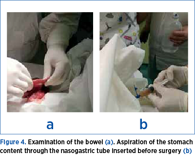 Figure 4. Examination of the bowel (a). Aspiration of the stomach content through the nasogastric tube inserted before surgery (b)