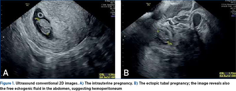 Figure 1. Ultrasound conventional 2D images. A) The intrauterine pregnancy. B) The ectopic tubal pregnancy; the image reveals also the free echogenic fluid in the abdomen, suggesting hemoperitoneum 