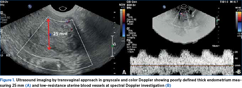 Figure 1. Ultrasound imaging by transvaginal approach in grayscale and color Doppler showing poorly defined thick endometrium measuring 25 mm (A) and low-resistance uterine blood vessels at spectral Doppler investigation (B)